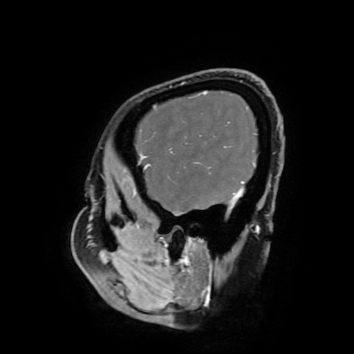 File:Chordoid glioma of third ventricle (Radiopaedia 91612-109340 F 176).jpg