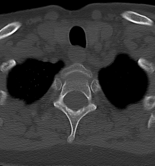 File:Chordoma (C4 vertebra) (Radiopaedia 47561-52188 Axial bone window 46).png