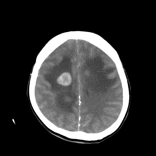 File:Choriocarcinoma of ovary with cerebral and pulmonary metastases (Radiopaedia 25983-26118 A 18).jpg