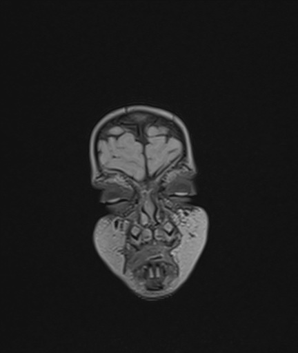 Choroid plexus papilloma (Radiopaedia 84612-100019 Coronal FLAIR 5).jpg