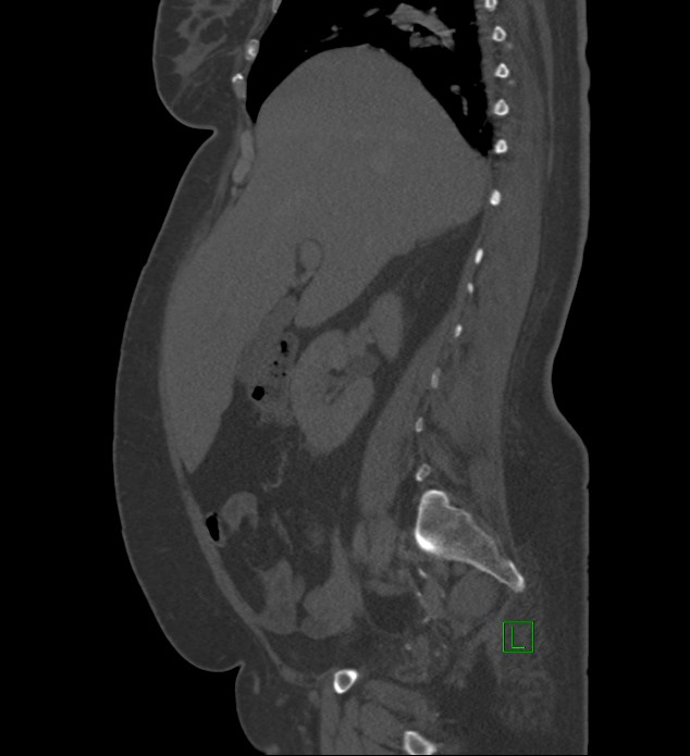 Chromophobe renal cell carcinoma (Radiopaedia 84239-99519 Sagittal bone window 70).jpg