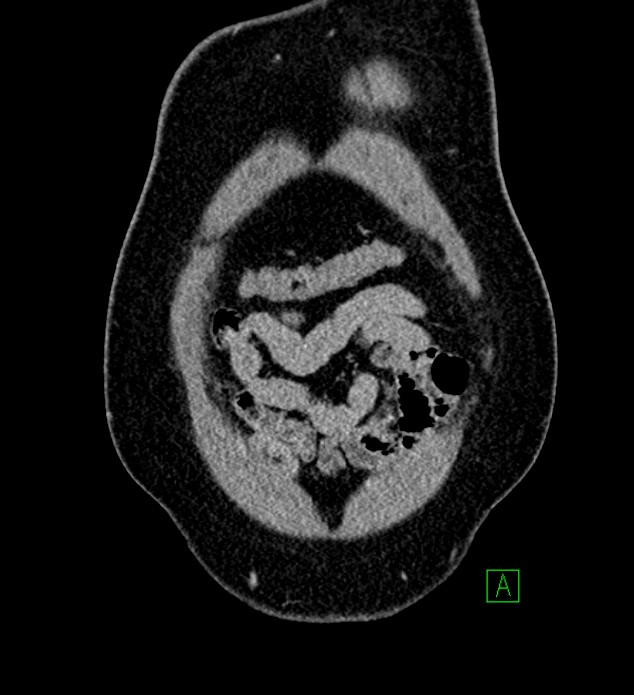 Chromophobe renal cell carcinoma (Radiopaedia 84286-99573 H 19).jpg
