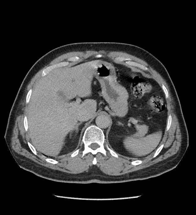 Chromophobe renal cell carcinoma (Radiopaedia 86879-103083 D 29).jpg