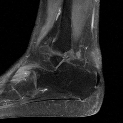 File:Chronic Achilles tendon rupture (Radiopaedia 15262-15100 C 3).jpg