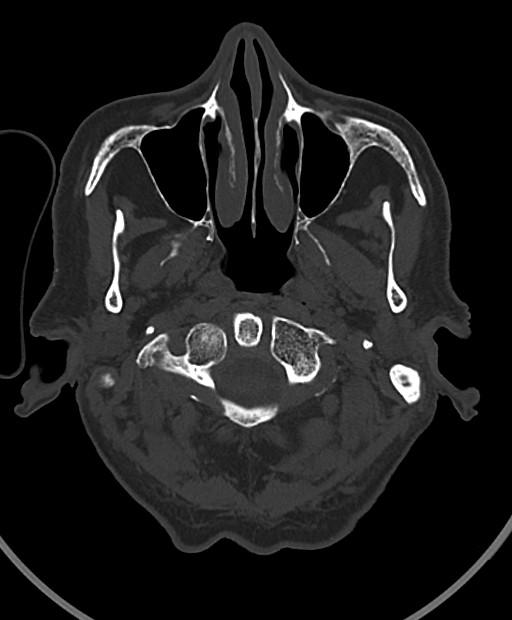 Chronic bilateral subdural hygroma (Radiopaedia 85801-101623 Axial bone window 112).jpg