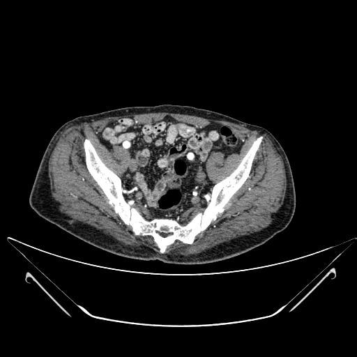 Chronic contained rupture of abdominal aortic aneurysm with extensive erosion of the vertebral bodies (Radiopaedia 55450-61901 A 64).jpg