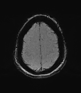 Chronic hypertensive encephalopathy (Radiopaedia 39993-42482 Axial SWI 76).png