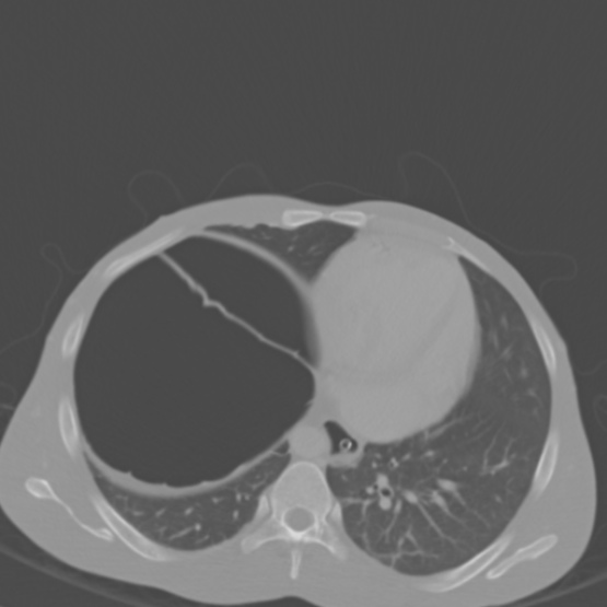 Chronic large bowel pseudo-obstruction (Radiopaedia 43181-46492 Axial bone window 26).jpg