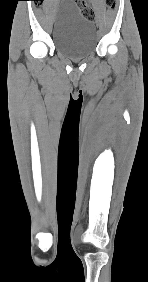 Chronic osteomyelitis (with sequestrum) (Radiopaedia 74813-85822 E 20).jpg