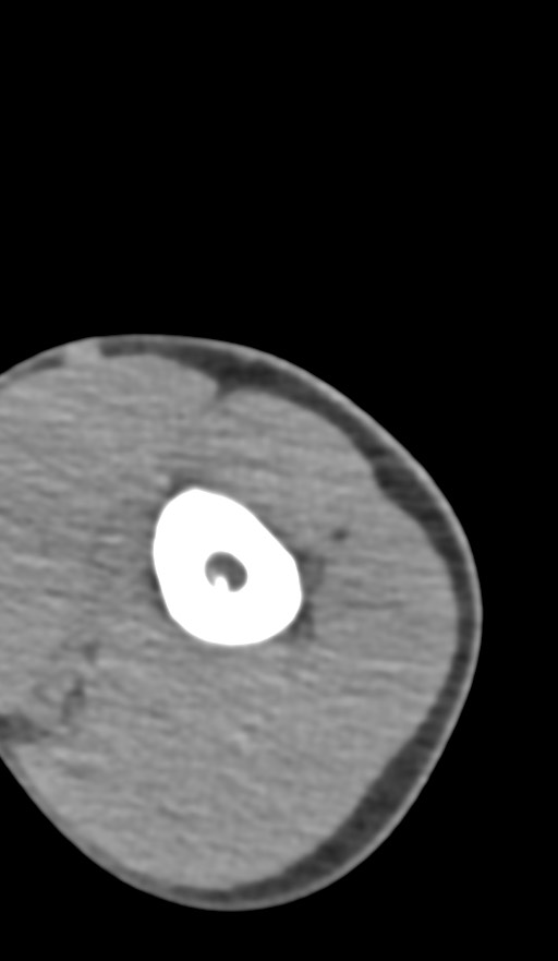 Chronic osteomyelitis of the distal humerus (Radiopaedia 78351-90971 Axial non-contrast 35).jpg