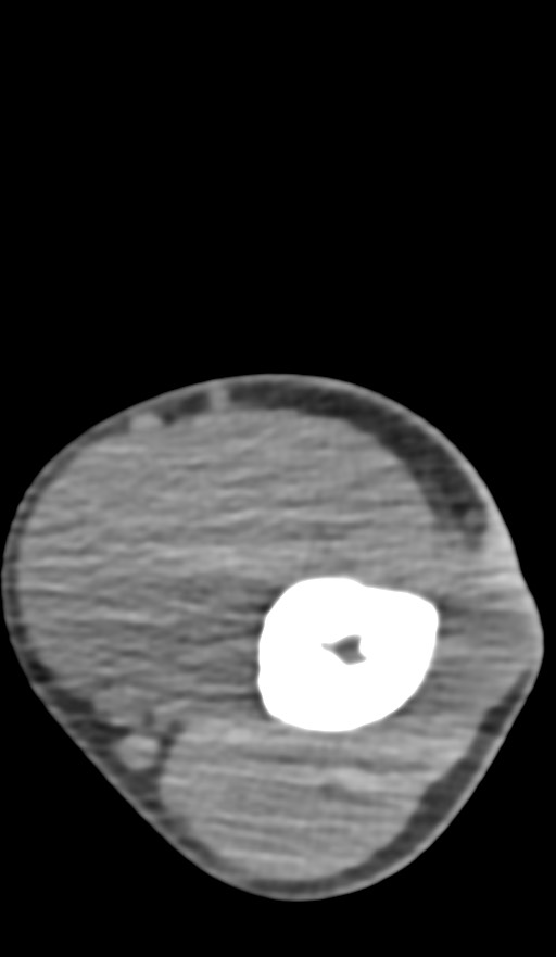 Chronic osteomyelitis of the distal humerus (Radiopaedia 78351-90971 Axial non-contrast 66).jpg