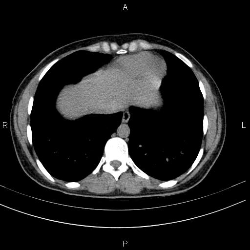 Chronic pancreatitis (Radiopaedia 64576-73450 Axial non-contrast 3).jpg