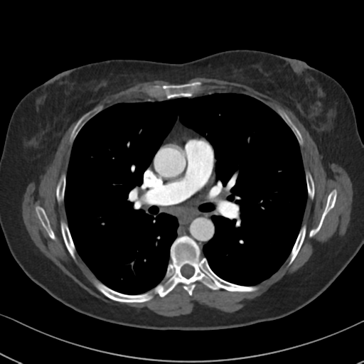 Chronic pulmonary embolus (Radiopaedia 39129-41341 Axial C+ CTPA 49).png