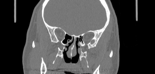 Chronic sphenoidal sinusitis (Radiopaedia 62030-70122 Coronal bone window 92).jpg