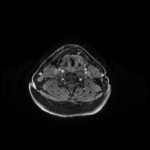 Chronic submandibular sialadenitis (Radiopaedia 61852-69885 Axial T1 C+ fat sat 29).jpg