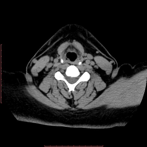 Chronic submandibular sialolithiasis (Radiopaedia 69817-79814 Axial non-contrast 160).jpg