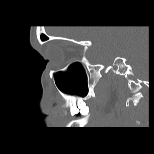 File:Cleft hard palate and alveolus (Radiopaedia 63180-71710 Sagittal bone window 18).jpg