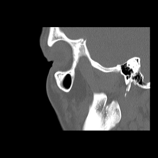 Cleft hard palate and alveolus (Radiopaedia 63180-71710 Sagittal bone window 39).jpg