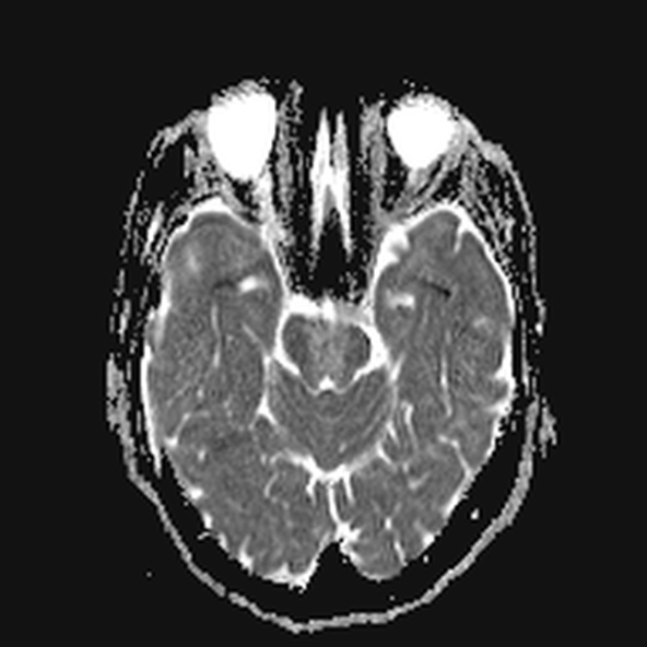 File:Clival meningioma (Radiopaedia 53278-59248 Axial ADC 8).jpg