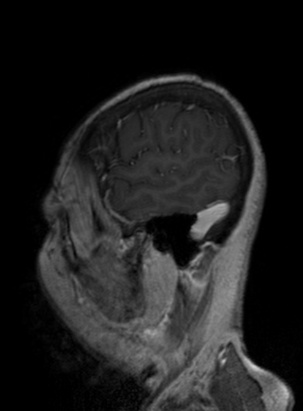 Clival meningioma (Radiopaedia 53278-59248 Sagittal T1 C+ 154).jpg