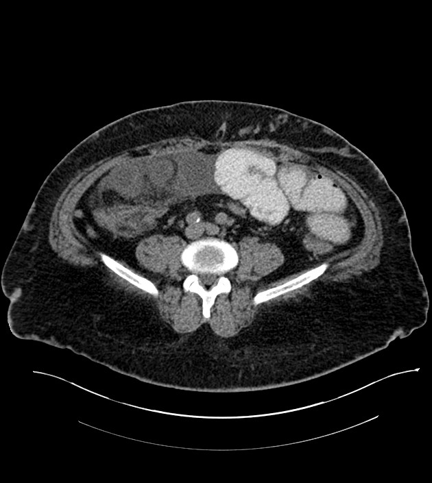 Closed-loop small bowel obstruction-internal hernia (Radiopaedia 78439-91096 Axial non-contrast 101).jpg