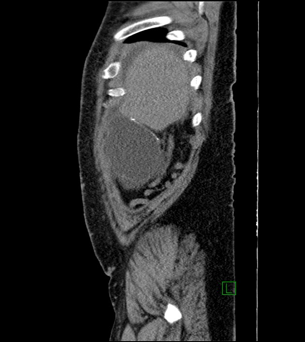 Closed-loop small bowel obstruction-internal hernia (Radiopaedia 78439-91096 C 126).jpg
