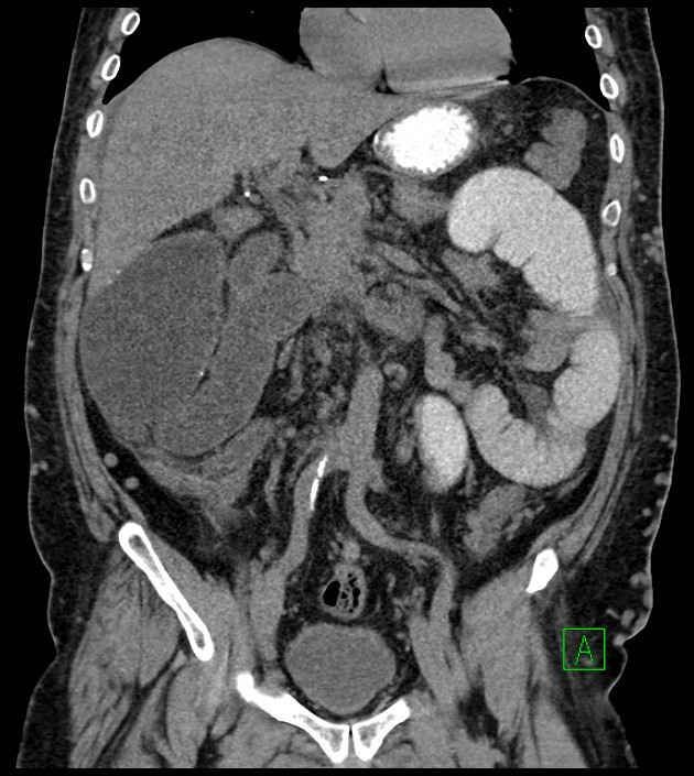 Closed-loop small bowel obstruction-internal hernia (Radiopaedia 78439-91096 Coronal non-contrast 48).jpg