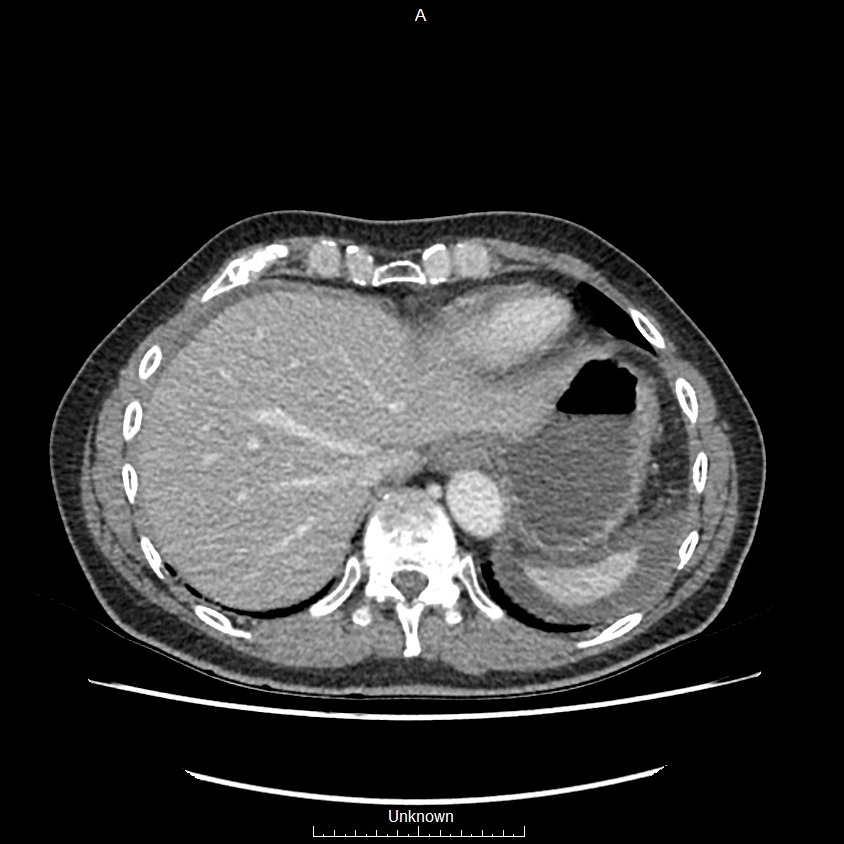 Closed loop bowel obstruction and ischemia (Radiopaedia 86959-103180 A 2).jpg
