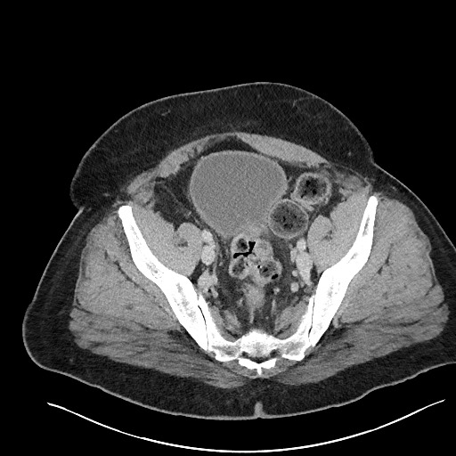 File:Closed loop obstruction - internal hernia into nephrectomy bed (Radiopaedia 59867-67320 A 118).jpg