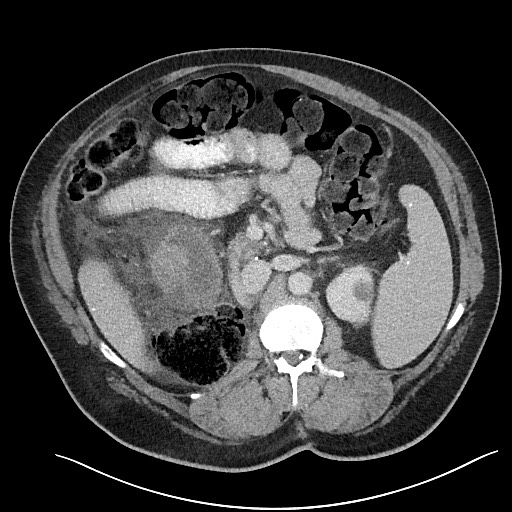 File:Closed loop obstruction - internal hernia into nephrectomy bed (Radiopaedia 59867-67320 A 52).jpg