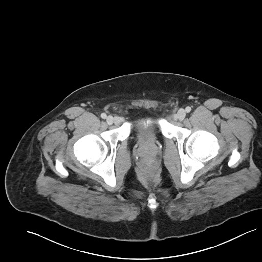 File:Closed loop obstruction - internal hernia into nephrectomy bed (Radiopaedia 59867-67320 Axial 138).jpg