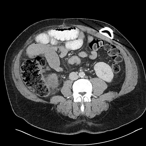 File:Closed loop obstruction - internal hernia into nephrectomy bed (Radiopaedia 59867-67320 Axial 20).jpg