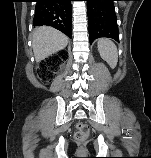 Closed loop obstruction - internal hernia into nephrectomy bed (Radiopaedia 59867-67320 B 109).jpg