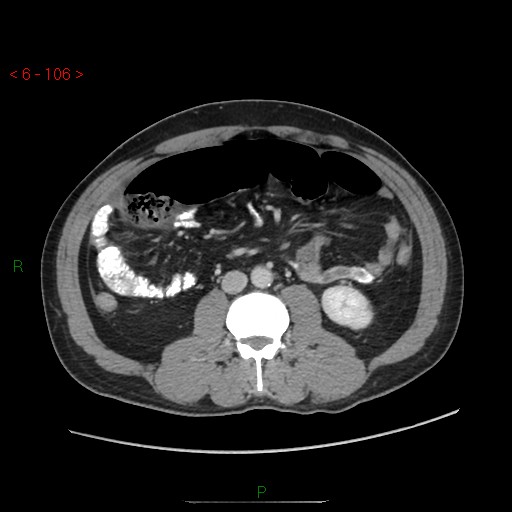File:Closed loop obstruction and appendicular stump mucocele (Radiopaedia 54014-60163 A 59).jpg