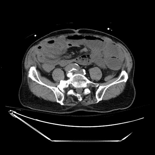 Closed loop obstruction due to adhesive band, resulting in small bowel ischemia and resection (Radiopaedia 83835-99023 Axial non-contrast 103).jpg