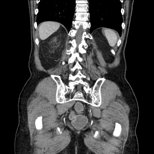 Closed loop obstruction due to adhesive band, resulting in small bowel ischemia and resection (Radiopaedia 83835-99023 E 101).jpg