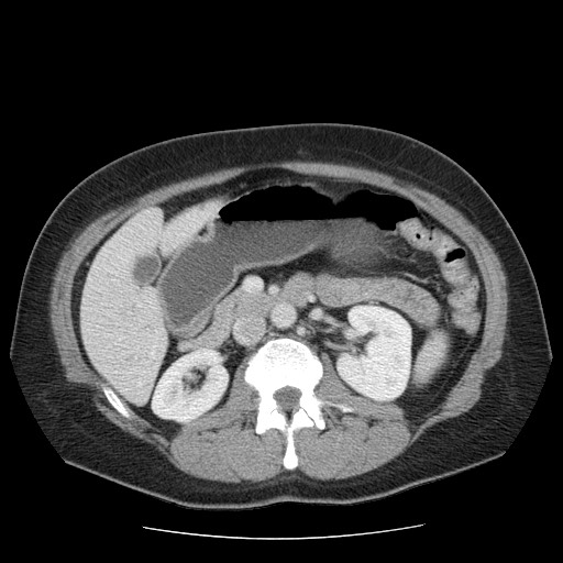 File:Closed loop small bowel obstruction (Radiopaedia 65403-74451 Axial 31).jpg