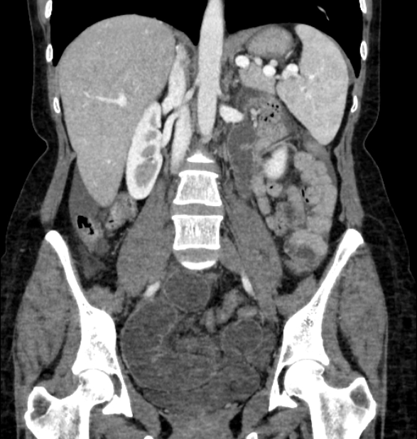 Closed loop small bowel obstruction (Radiopaedia 71211-81508 B 69).jpg