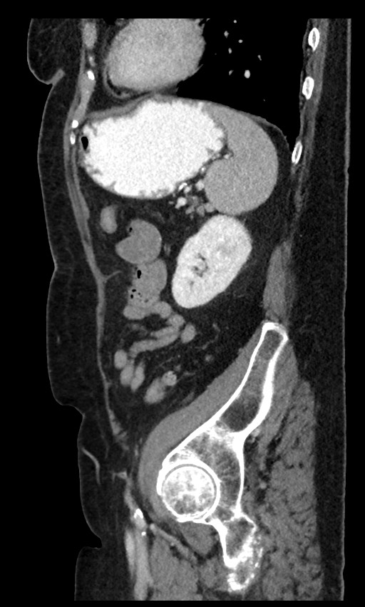 Closed loop small bowel obstruction - adhesions (Radiopaedia 59269-66611 C 31).jpg