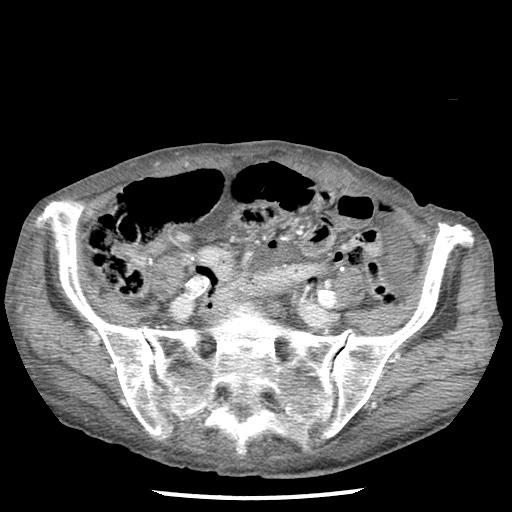 Closed loop small bowel obstruction - adhesions and infarct (Radiopaedia 85125-100678 B 71).jpg