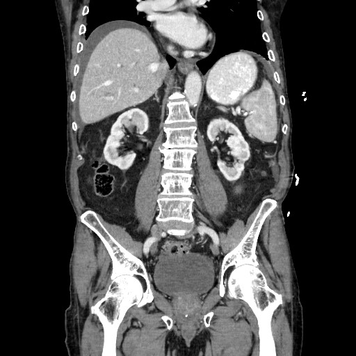 Closed loop small bowel obstruction - adhesive disease and hemorrhagic ischemia (Radiopaedia 86831-102990 B 79).jpg