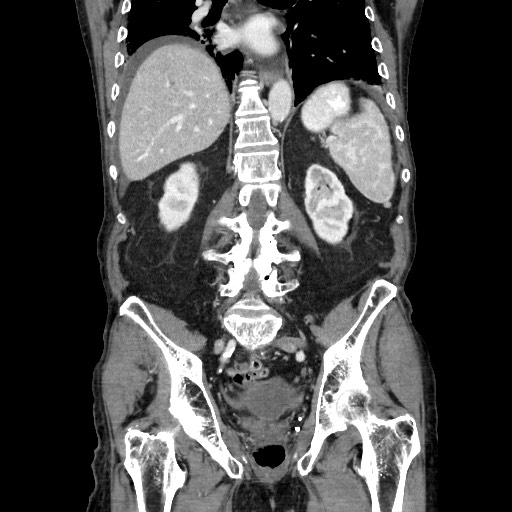 Closed loop small bowel obstruction - adhesive disease and hemorrhagic ischemia (Radiopaedia 86831-102990 B 87).jpg
