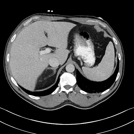 File:Closed loop small bowel obstruction - internal hernia (Radiopaedia 57806-64778 B 27).jpg