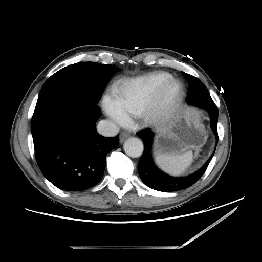 Closed loop small bowel obstruction - omental adhesion causing "internal hernia" (Radiopaedia 85129-100682 A 11).jpg