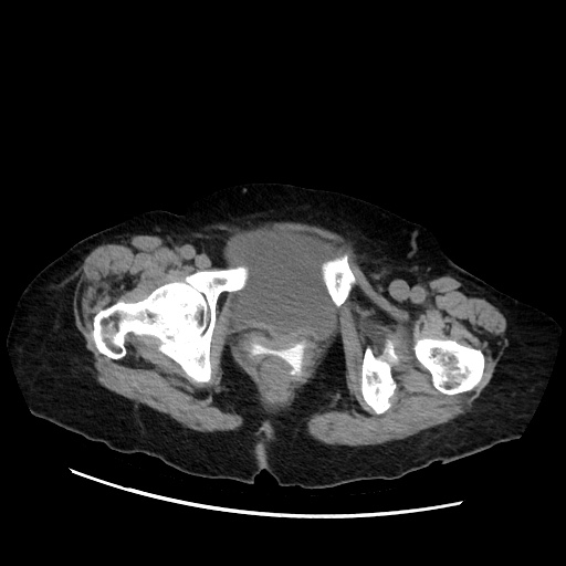 Closed loop small bowel obstruction due to adhesive band, with intramural hemorrhage and ischemia (Radiopaedia 83831-99017 Axial non-contrast 155).jpg