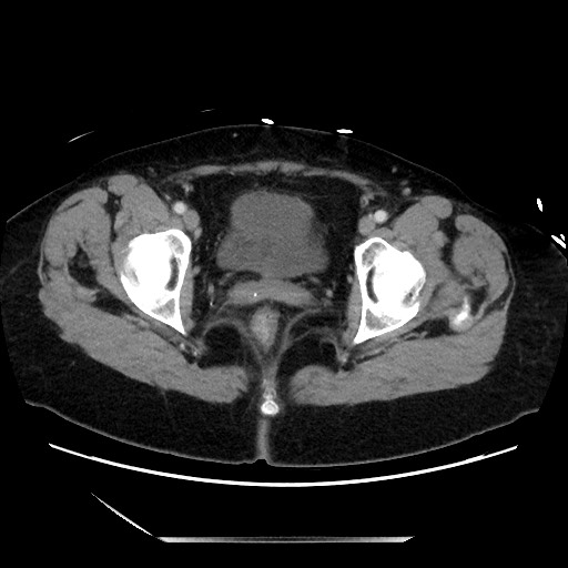 Closed loop small bowel obstruction due to adhesive bands - early and late images (Radiopaedia 83830-99014 A 144).jpg