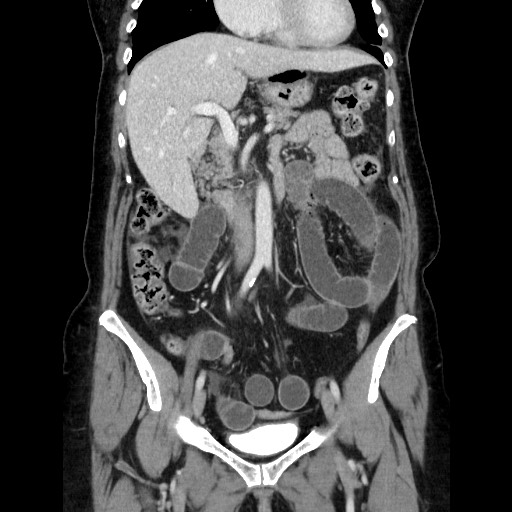 Closed loop small bowel obstruction due to adhesive bands - early and late images (Radiopaedia 83830-99015 B 54).jpg