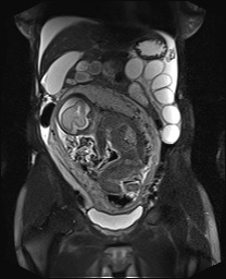 File:Closed loop small bowel obstruction in pregnancy (MRI) (Radiopaedia 87637-104031 Coronal T2 fat sat 26).jpg