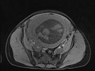Closed loop small bowel obstruction in pregnancy (MRI) (Radiopaedia 87637-104031 F 40).jpg