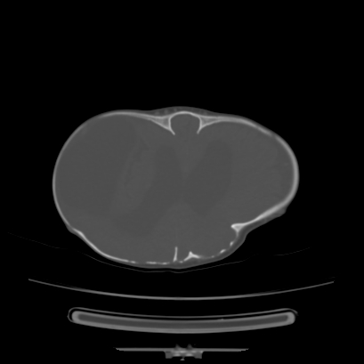 Cloverleaf skull (Radiopaedia 91901-109710 Axial bone window 108).jpg